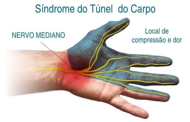 Síndrome do túnel do carpo