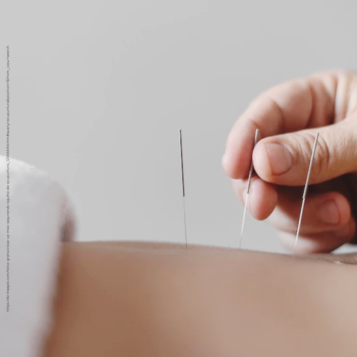 ACUPUNTURA