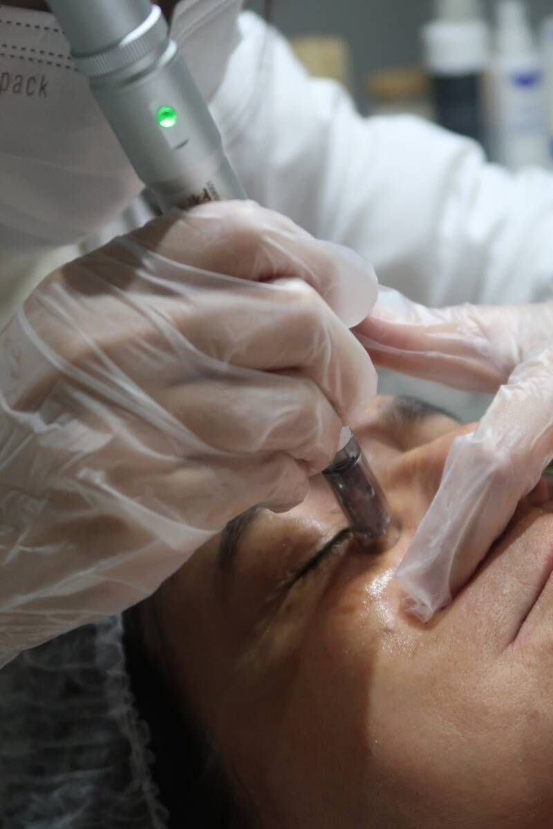 Microagulhamento - Foto 1