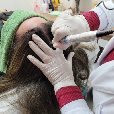 Microagulhamento Capilar - Foto 1