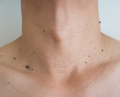 Remoção de verrugas e sinais - Foto 1