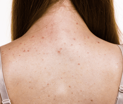 Tratamento de Oleosidade e Acne Corporal - Foto 1