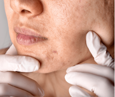 Tratamento para Acne - Foto 1