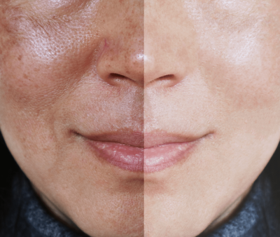 Tratamento para Melasma - Foto 1