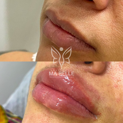 Preenchimento Labial - Foto 1