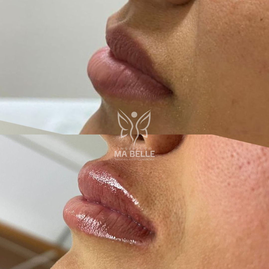Preenchimento Labial - Foto 2