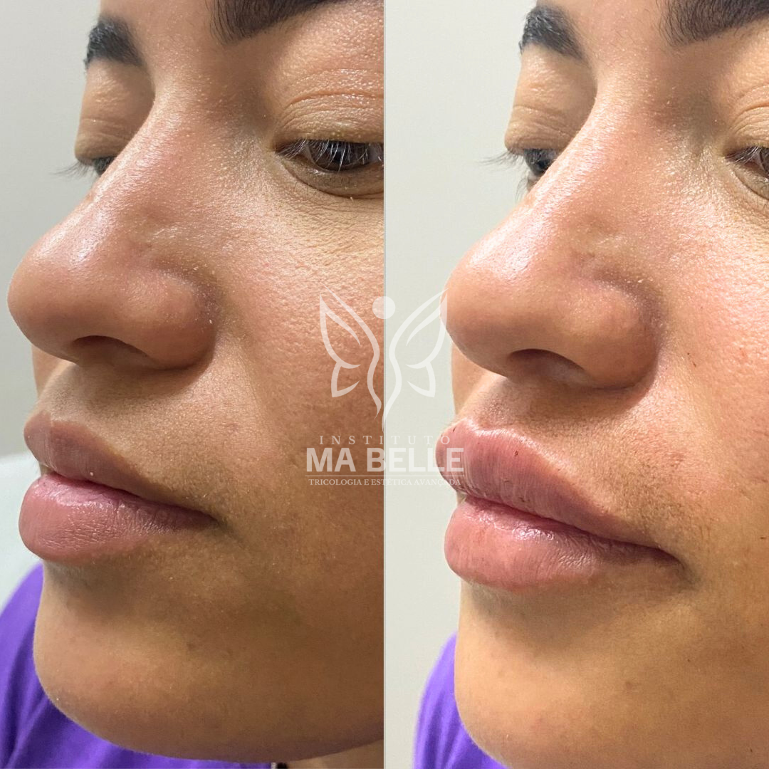 Preenchimento Labial - Foto 3