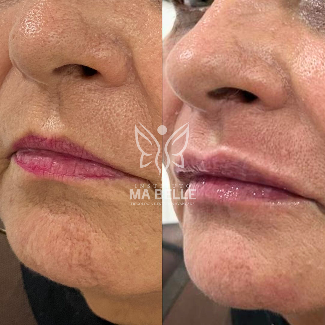 Preenchimento Labial - Foto 4
