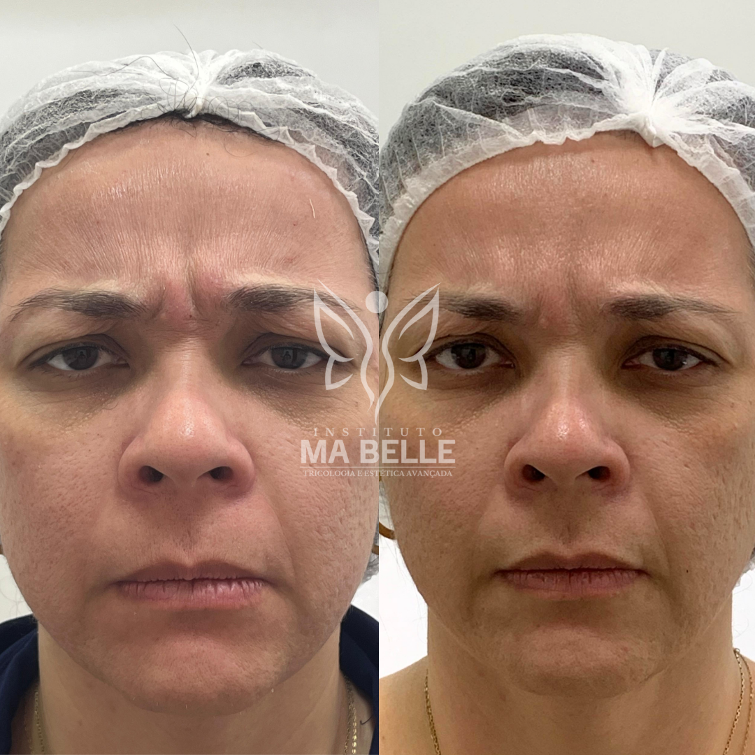 Toxina Botulínica (Botox) - Foto 1