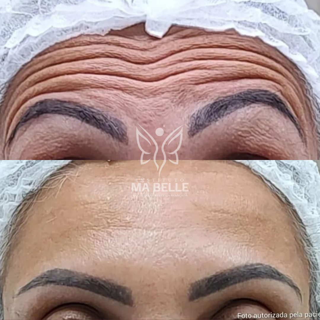 Toxina Botulínica (Botox) - Foto 2