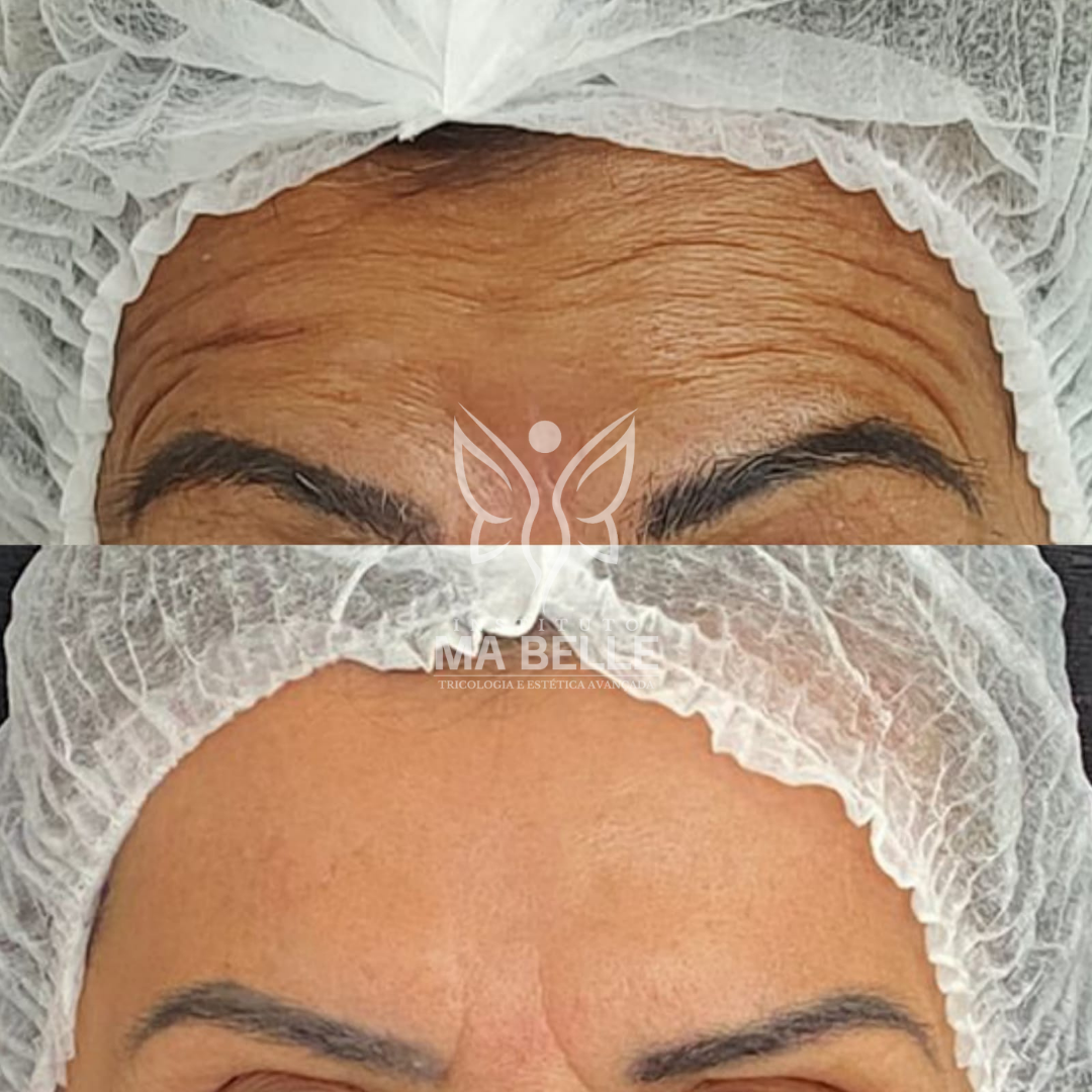 Toxina Botulínica (Botox) - Foto 3