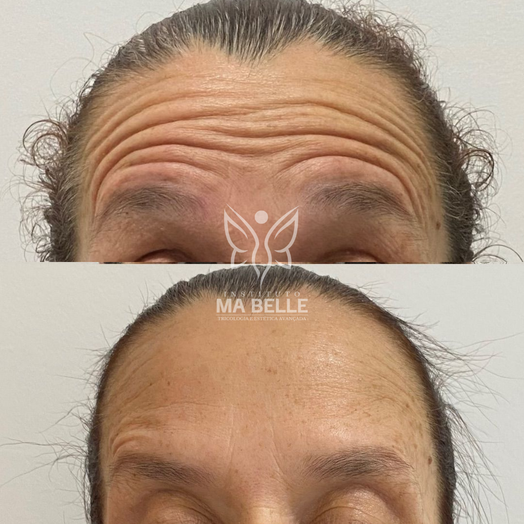 Toxina Botulínica (Botox) - Foto 4