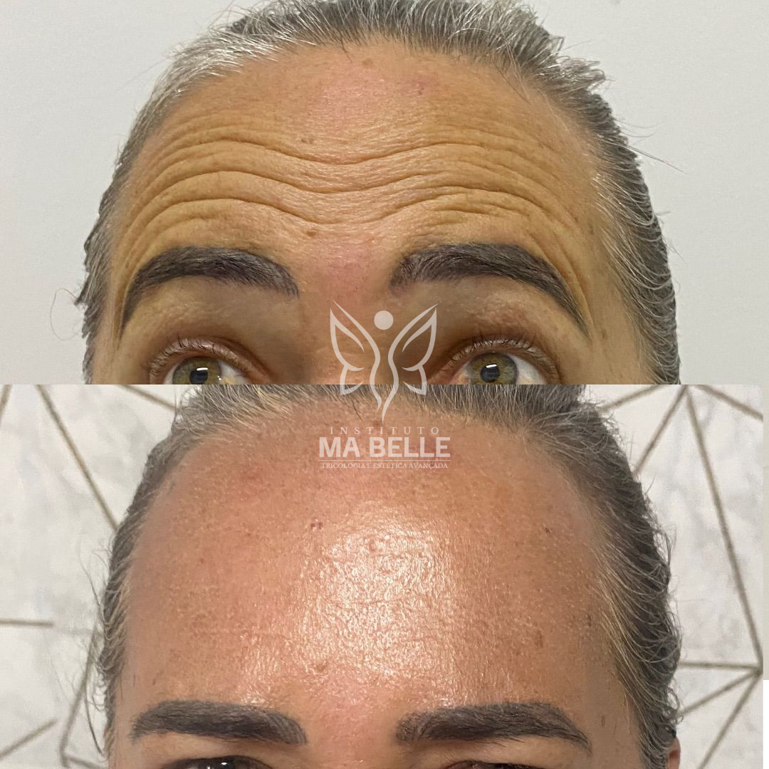 Toxina Botulínica (Botox) - Foto 5