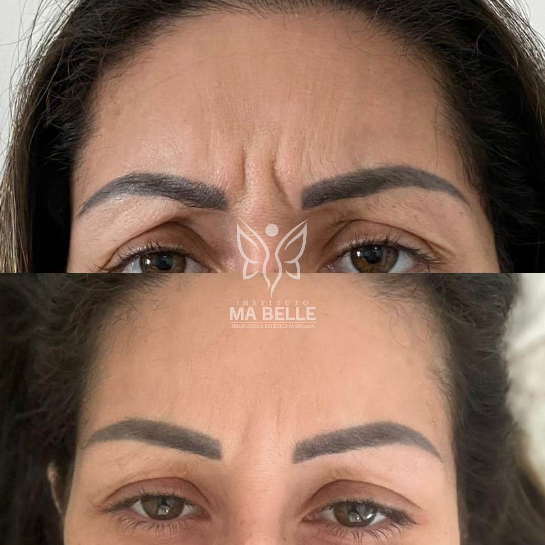 Toxina Botulínica (Botox) - Foto 6