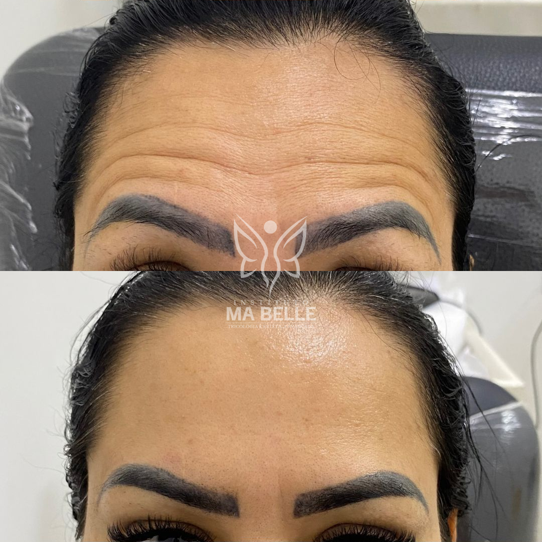 Toxina Botulínica (Botox) - Foto 7