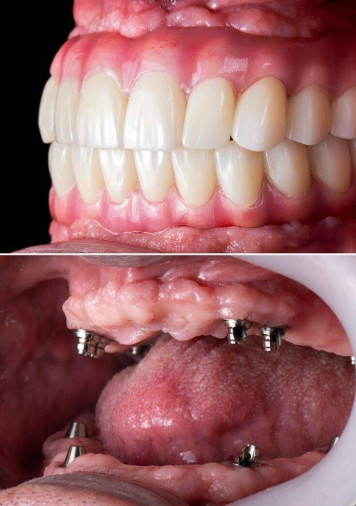 Implantes e Próteses Digitais - Foto 1