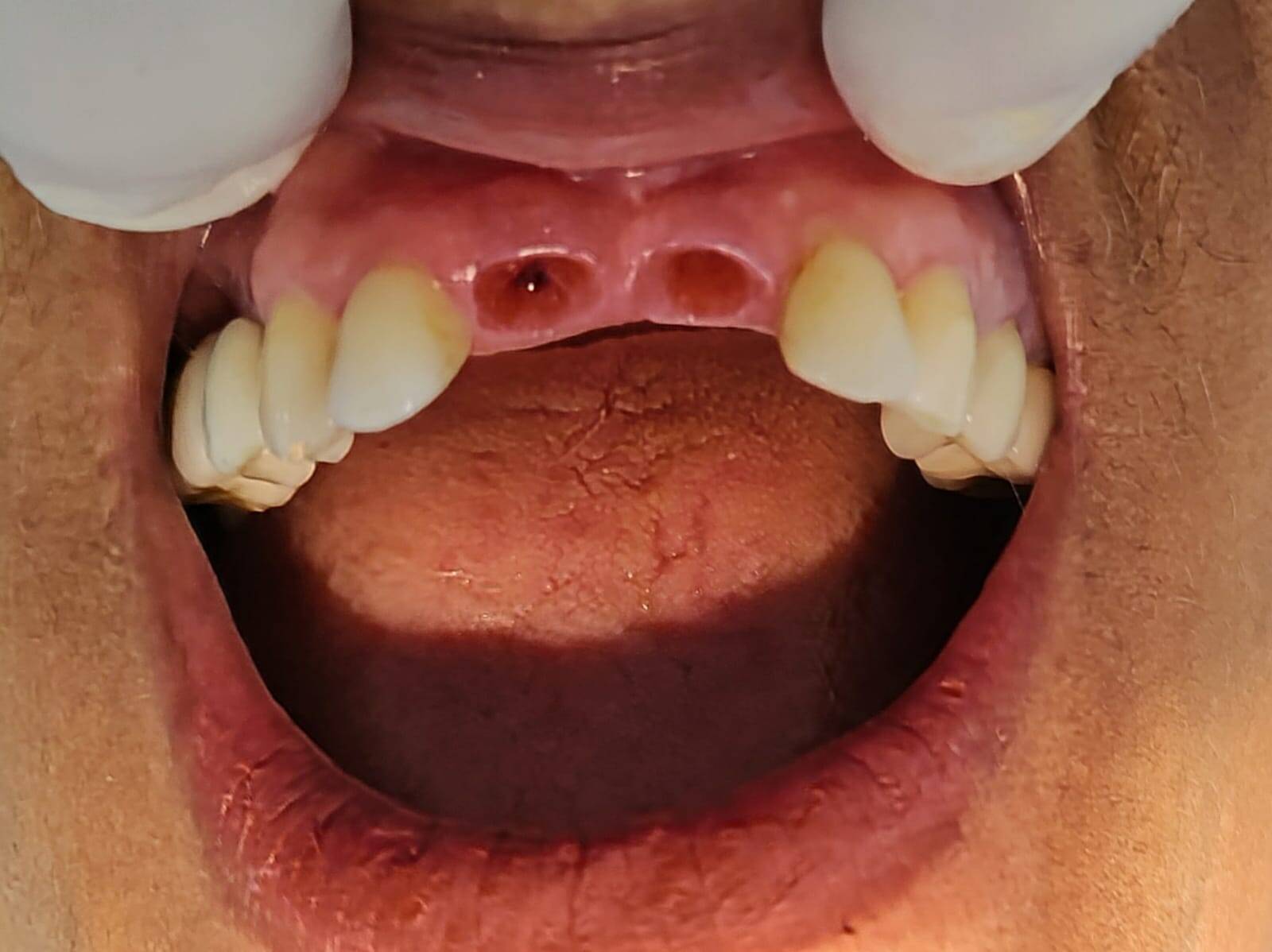 IMPLANTE E PROTESE SOBRE IMPLANTE