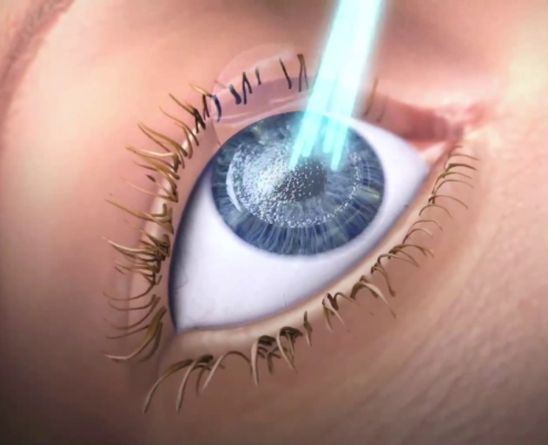 LASER REFRATIVO - Foto 1