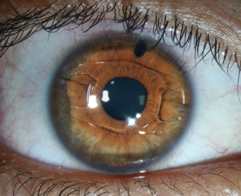 LENTE FÁCICA - Foto 1