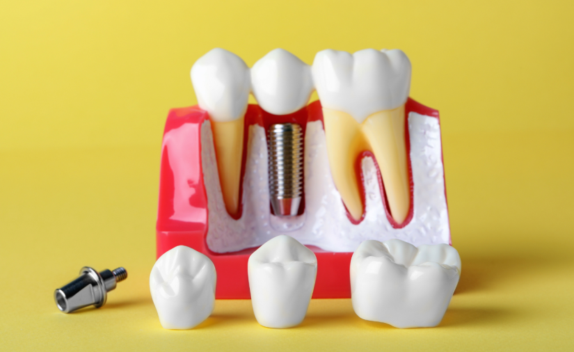 Implantodontia - Foto 1