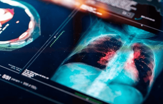 Lei institui campanha para conscientização sobre câncer de pulmão