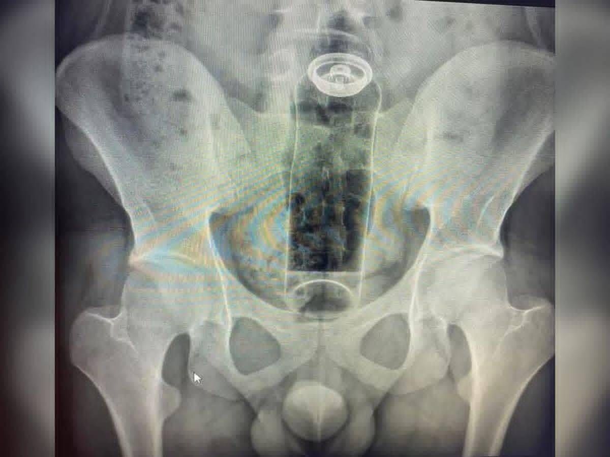 Jovem é hospitalizado após embalagem de desodorante ficar presa no ânus