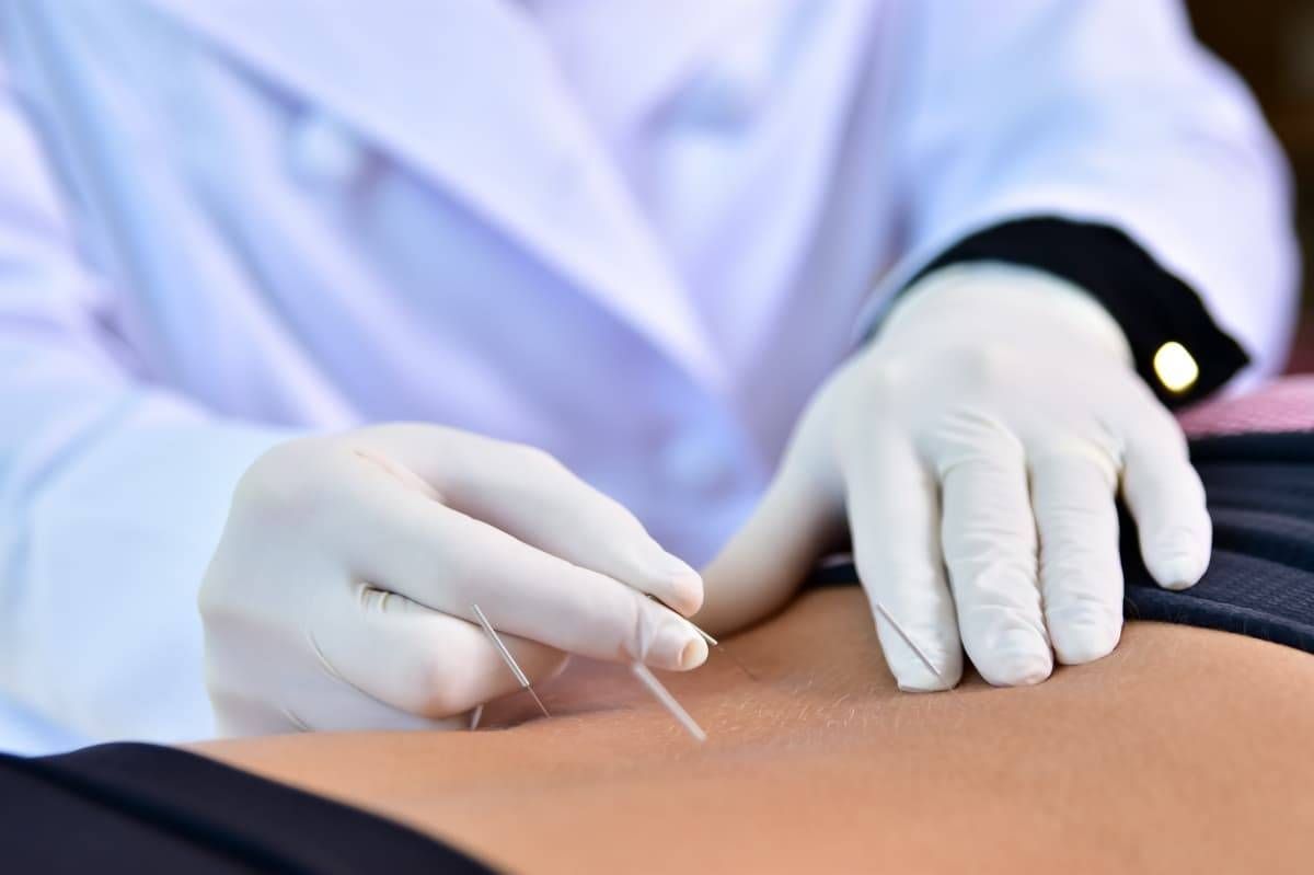 ACUPUNTURA E DRY NEEDLING - Foto 2