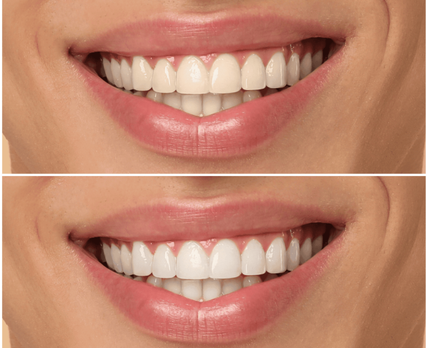Clareamento Dental - Foto 1