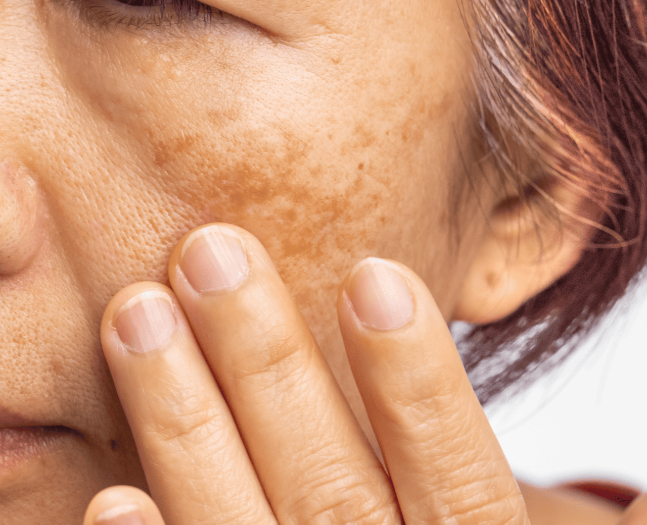 Correção de Pigmentação Facial - Foto 1