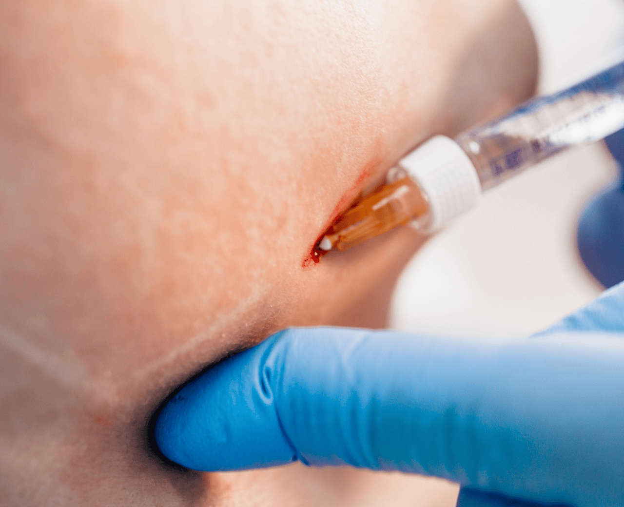 Intradermoterapia Facial e Corporal - Foto 1