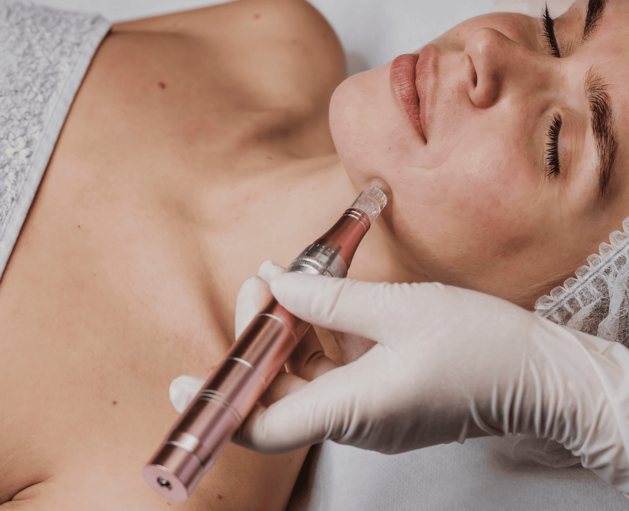 Microagulhamento com Drug Delivery - Foto 1